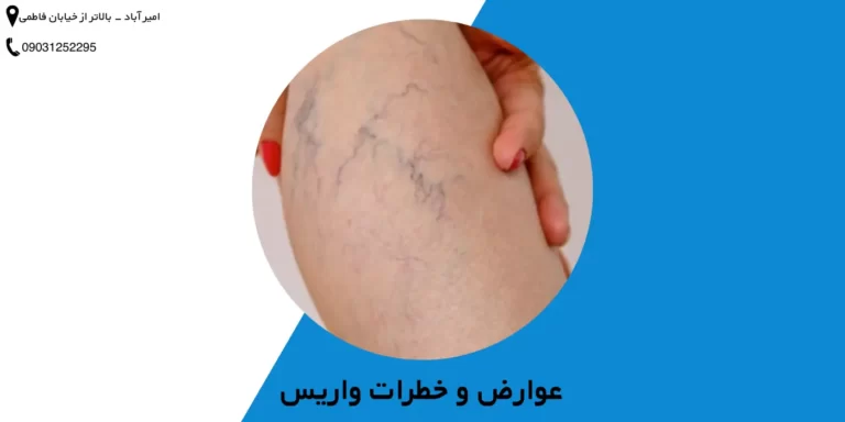 عوارض و خطرات واریس پا