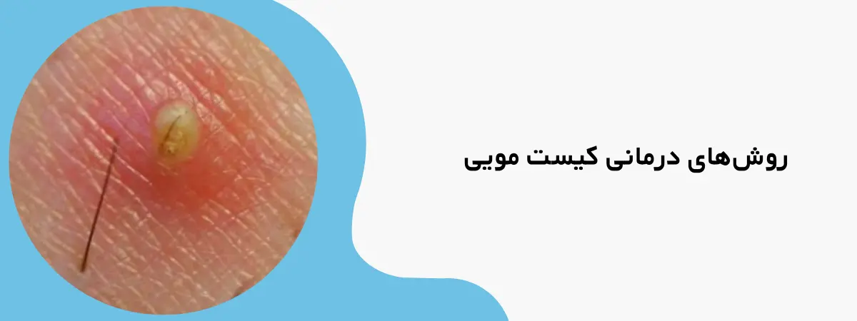 بهترین درمان کیست مویی
