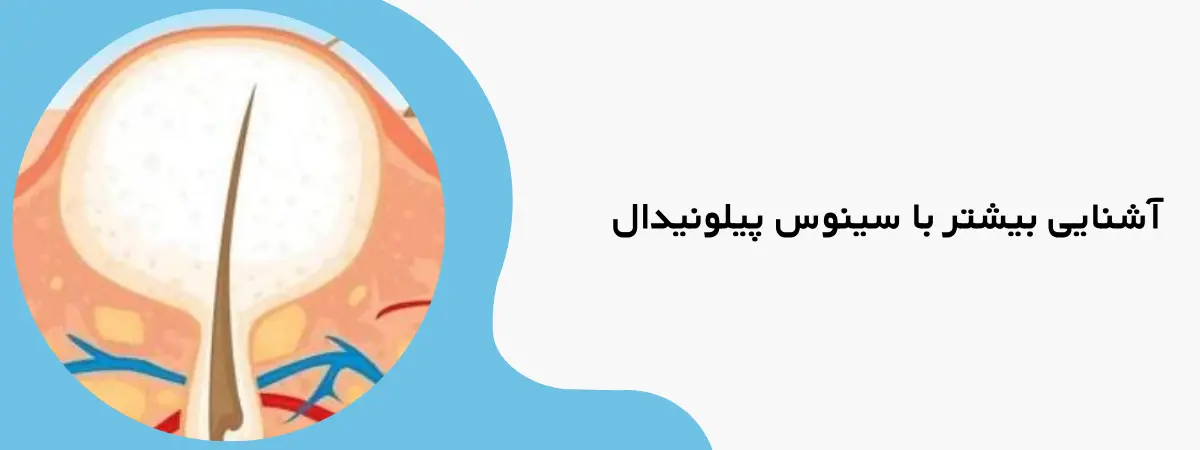 کیست پیلونیدال چیست؟
