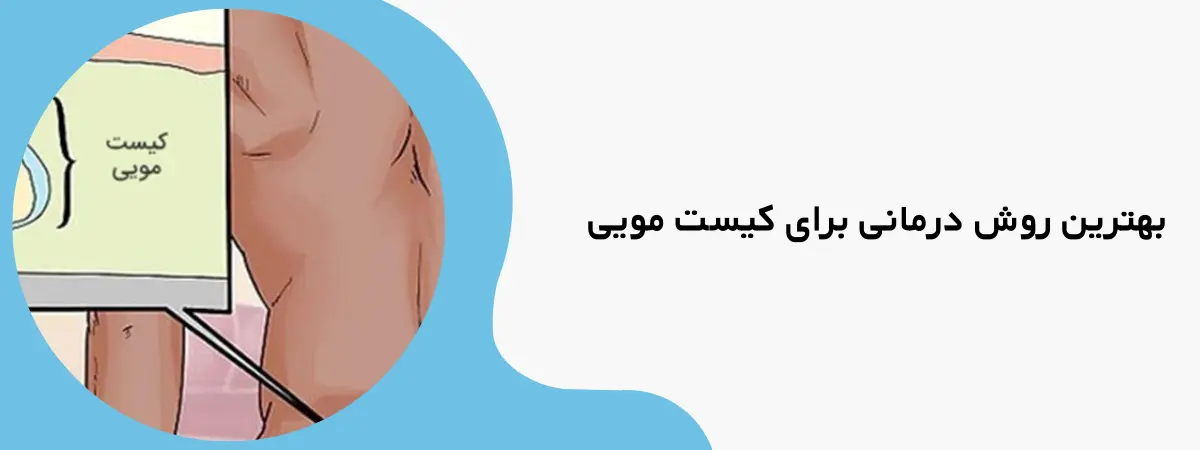 پماد کیست مویی
