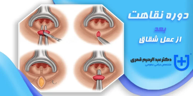 دوره نقاهت بعد از عمل شقاق (مراقبت ها)