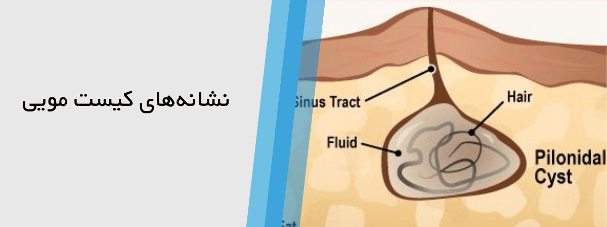علائم کیست مویی عفونی