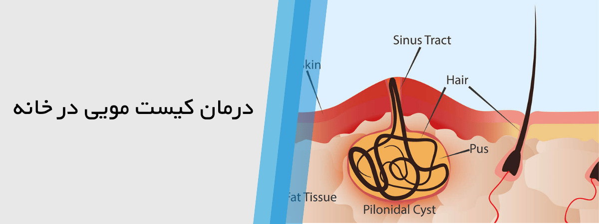 درمان کیست مویی با داروهای گیاهی موثر در خانه