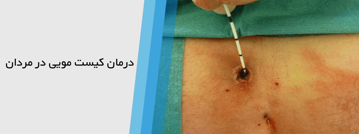 بهترین درمان کیست مویی در آقایان