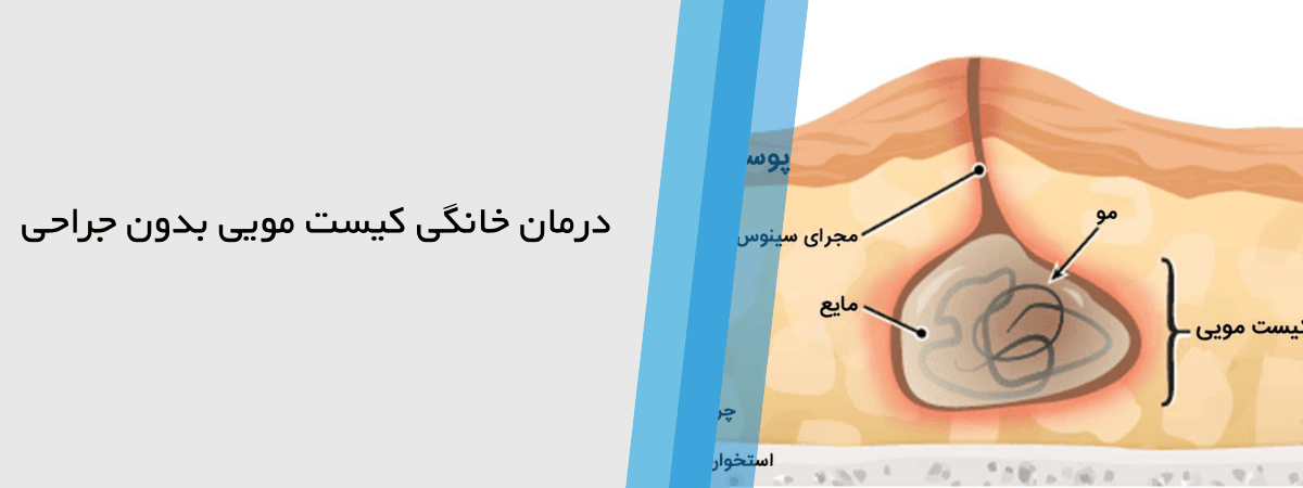درمان بدون جراحی کیست مویی در منزل