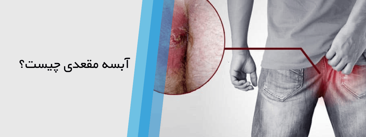 بیماری آبسه مقعدی یا جوش مقعدی