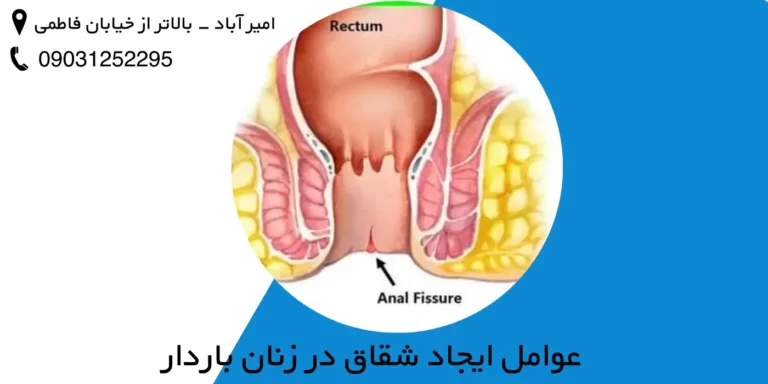 درمان شقاق در بارداری (شقاق در زنان باردار)