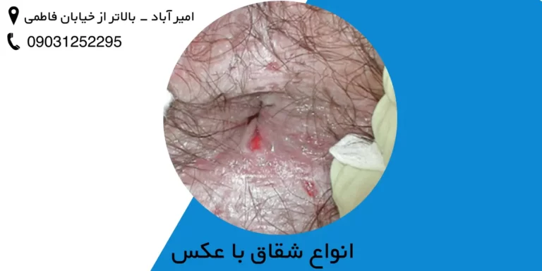 انواع شقاق با عکس – تصاویر انواع شقاق
