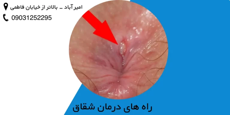 راه های درمان شقاق مقعدی