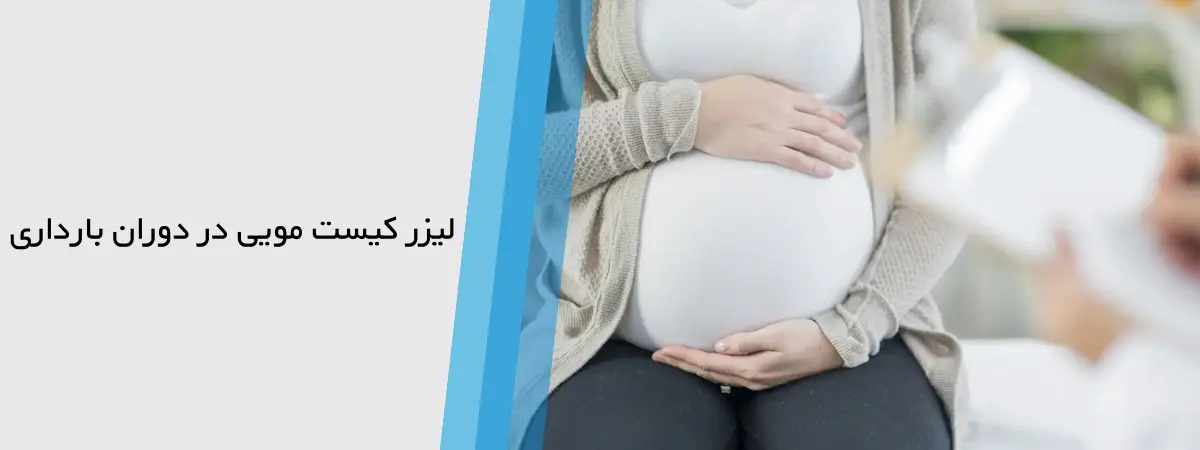 درمان کیست مویی با لیزر در بارداری