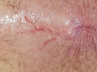 شقاق مزمن (Chronic anal fissure)