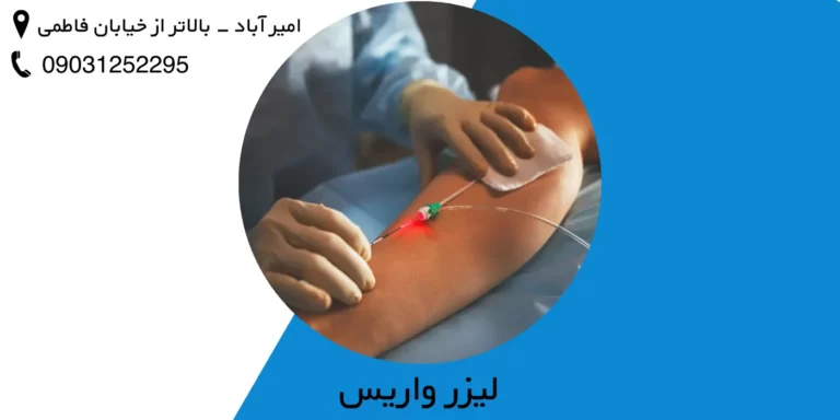 لیزر واریس پا (درمان واریس با لیزر)