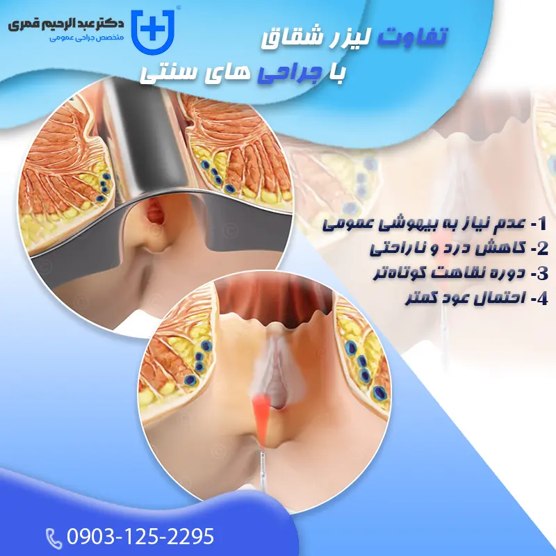 نکات مهم در مورد لیزر شقاق که باید بدانید