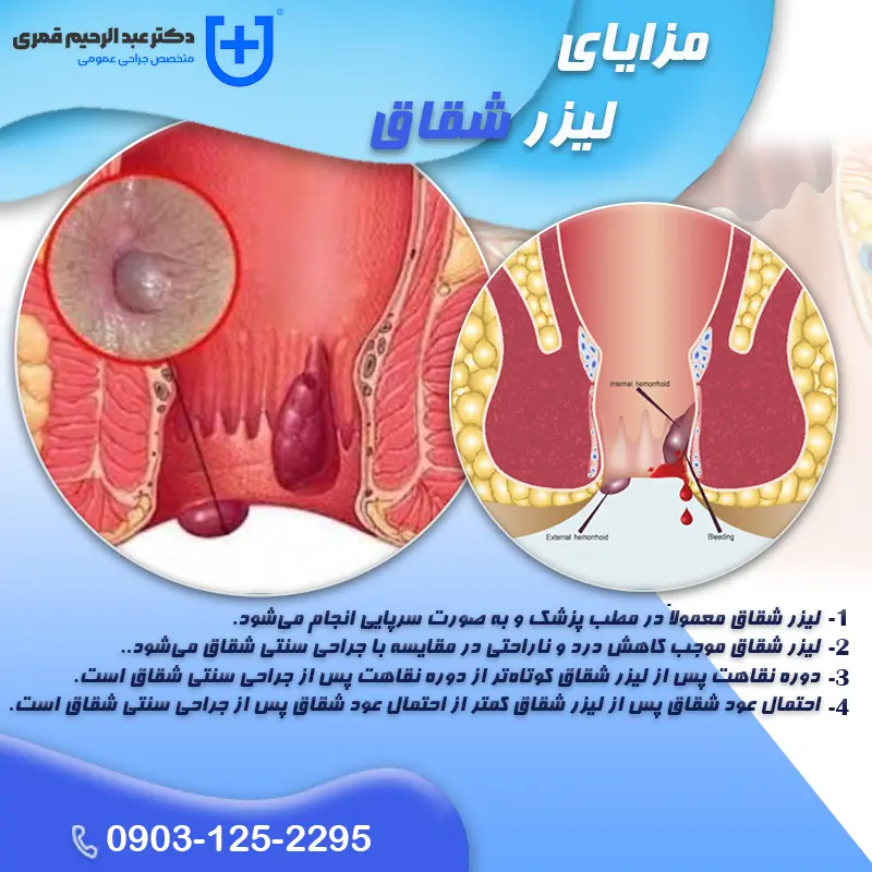 مزایا لیزر شقاق