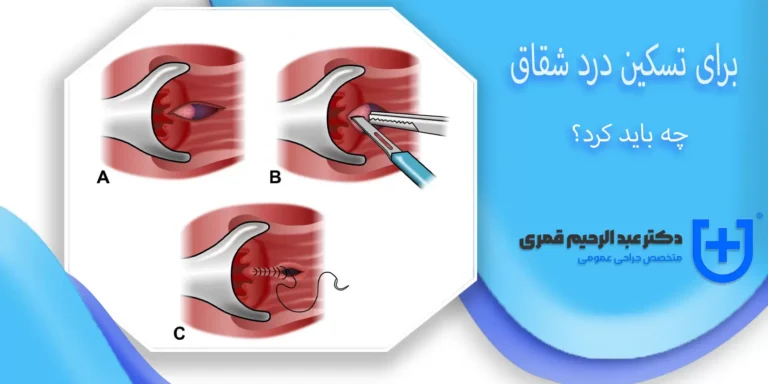 برای تسکین درد شقاق چه باید کرد؟