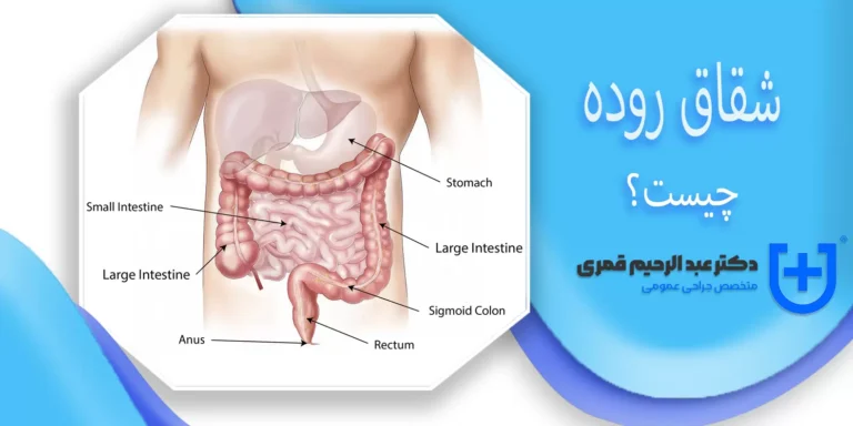 شقاق روده چیست؟