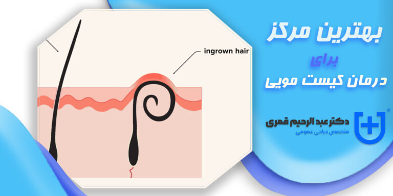 بهترین مرکز برای درمان کیست مویی
