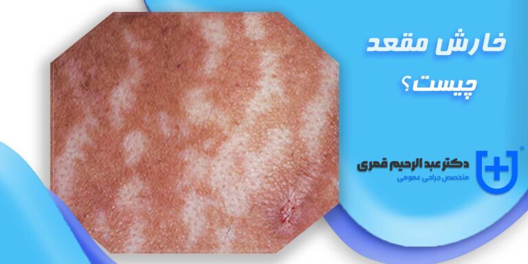 خارش مقعدی نشانه چیست؟ | دلیل خارش مقعد