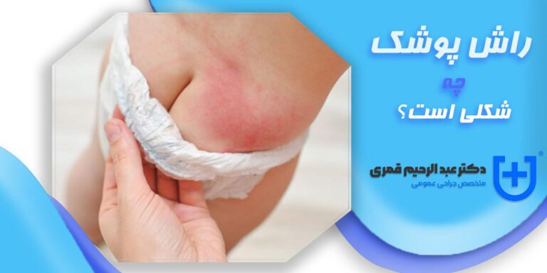 راش پوشک (درماتیت پوشکی)