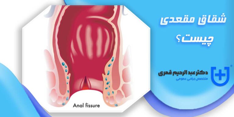 شقاق مقعدی