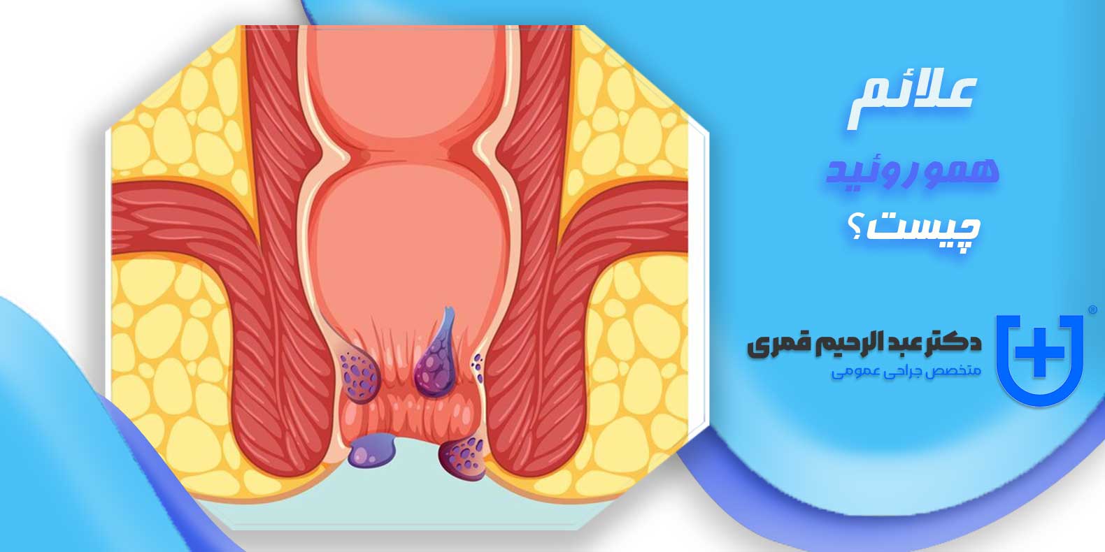 علائم بواسیر 