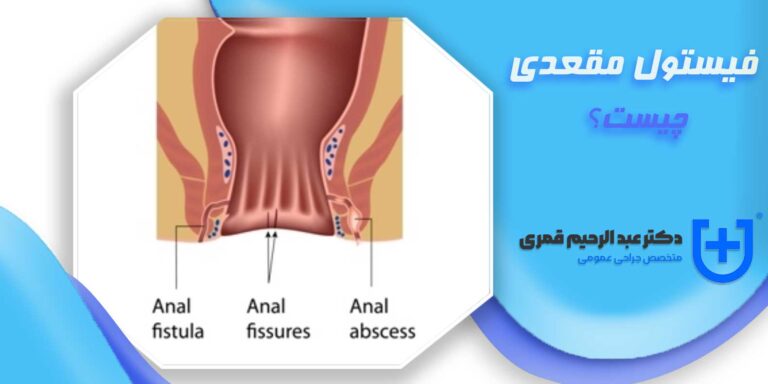 فیستول مقعدی