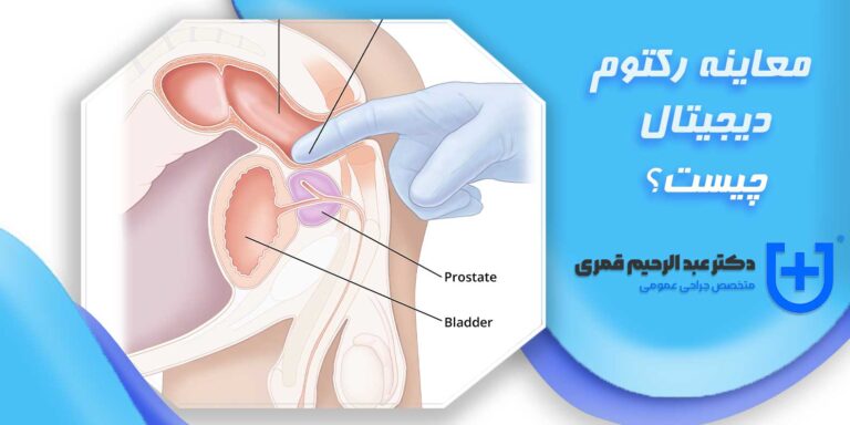 معاینه رکتوم دیجیتال