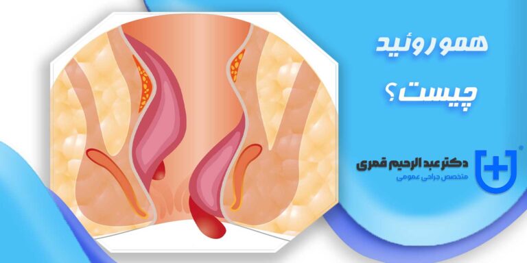 انواع هموروئید چیست؟