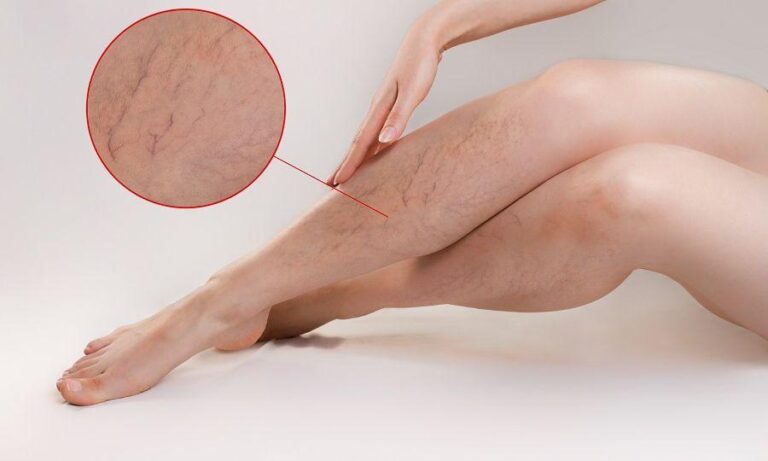 نقشه برداری از رگ های واریسی دردناک است؟