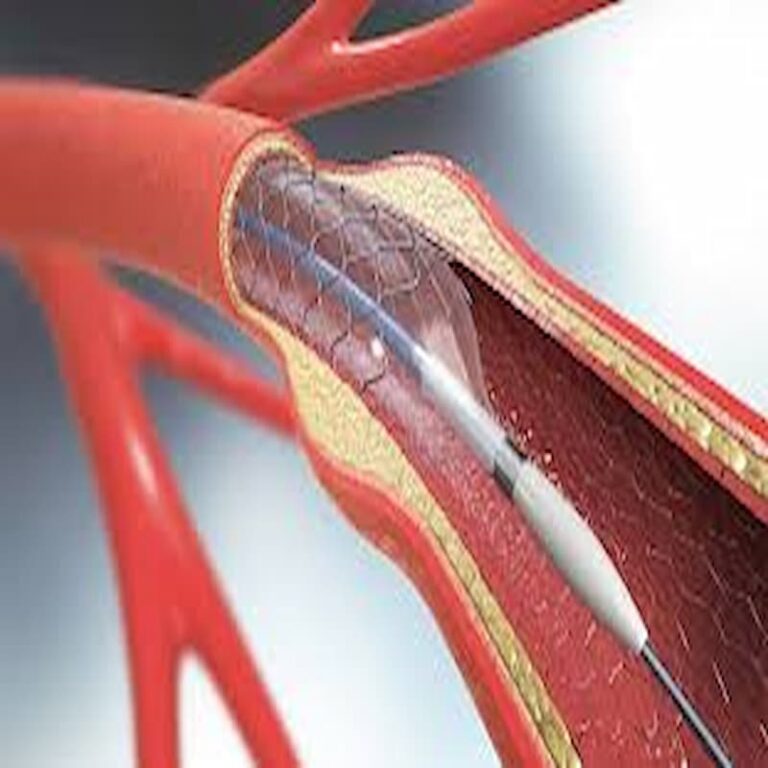 خطرات و روش کار استنت گذاری وریدی