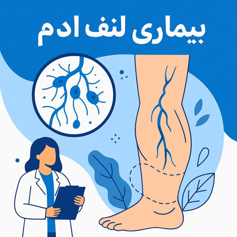 پیشگیری و درمان بیماری لنف ادم