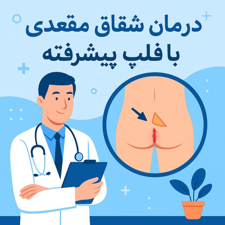 درمان شقاق مقعدی با فلپ پیشرفته مقعدی