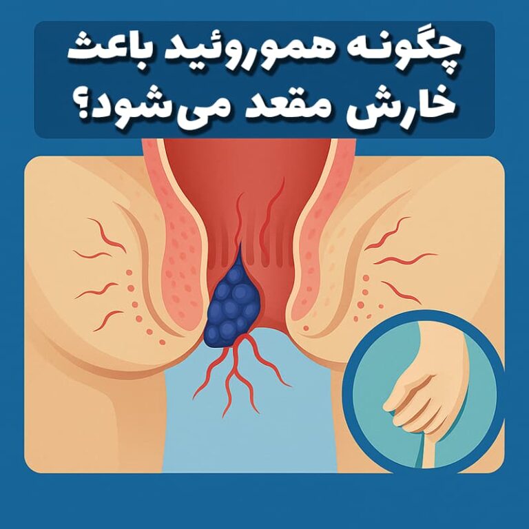 چگونه هموروئید باعث خارش مقعد می‌شود؟ راهکارهای کنترل و درمان